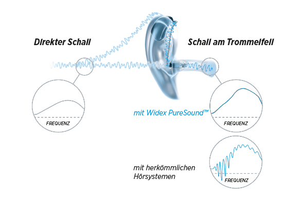 Widex PureSound™-Technologie