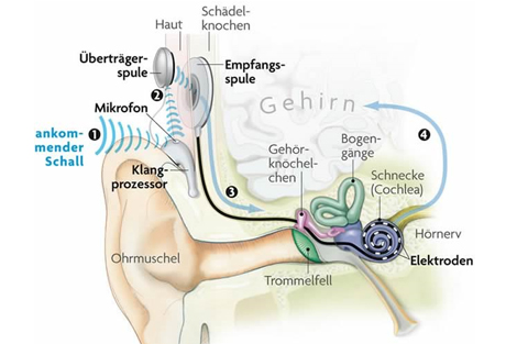 Cochlea-Implantat
