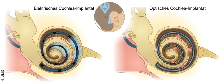 Optisches Cochlea-Implantat