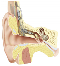 vollimplantierbares Hörgerät Carina