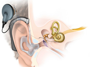 Cochlea Implantat