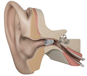 Starkey SoundLens Kassel