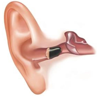 Starkey SoundLens - für nahezu unsichtbares HörenLorem